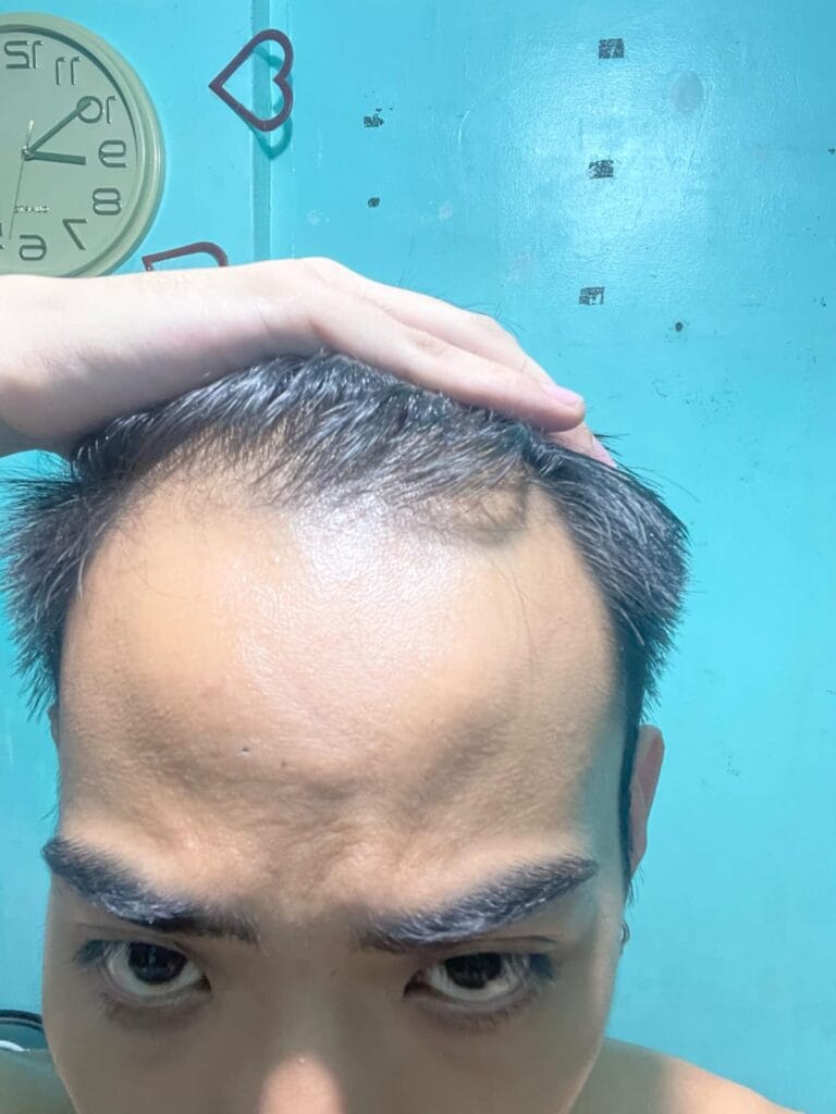 Hair loss